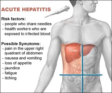 Acute Hepatitus